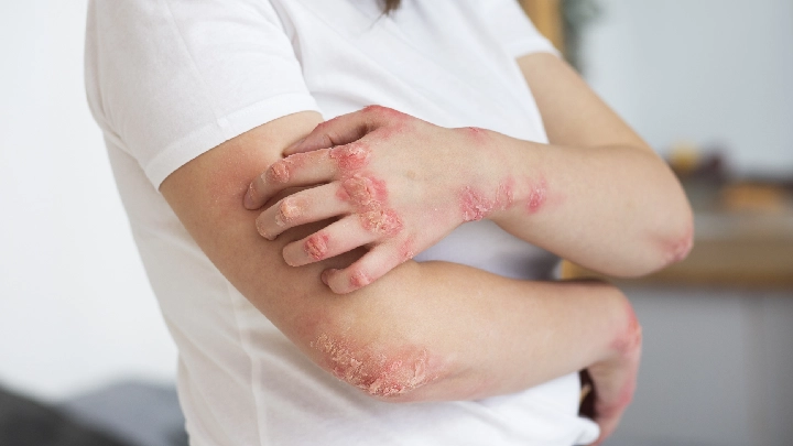 Psoriasis'in Belirtileri Nelerdir?